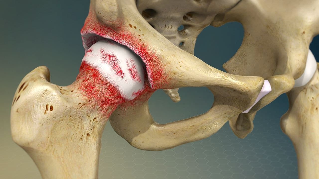 Illustration of a hip joint with worn cartilage at the femoral head and inflammation across the joint surface