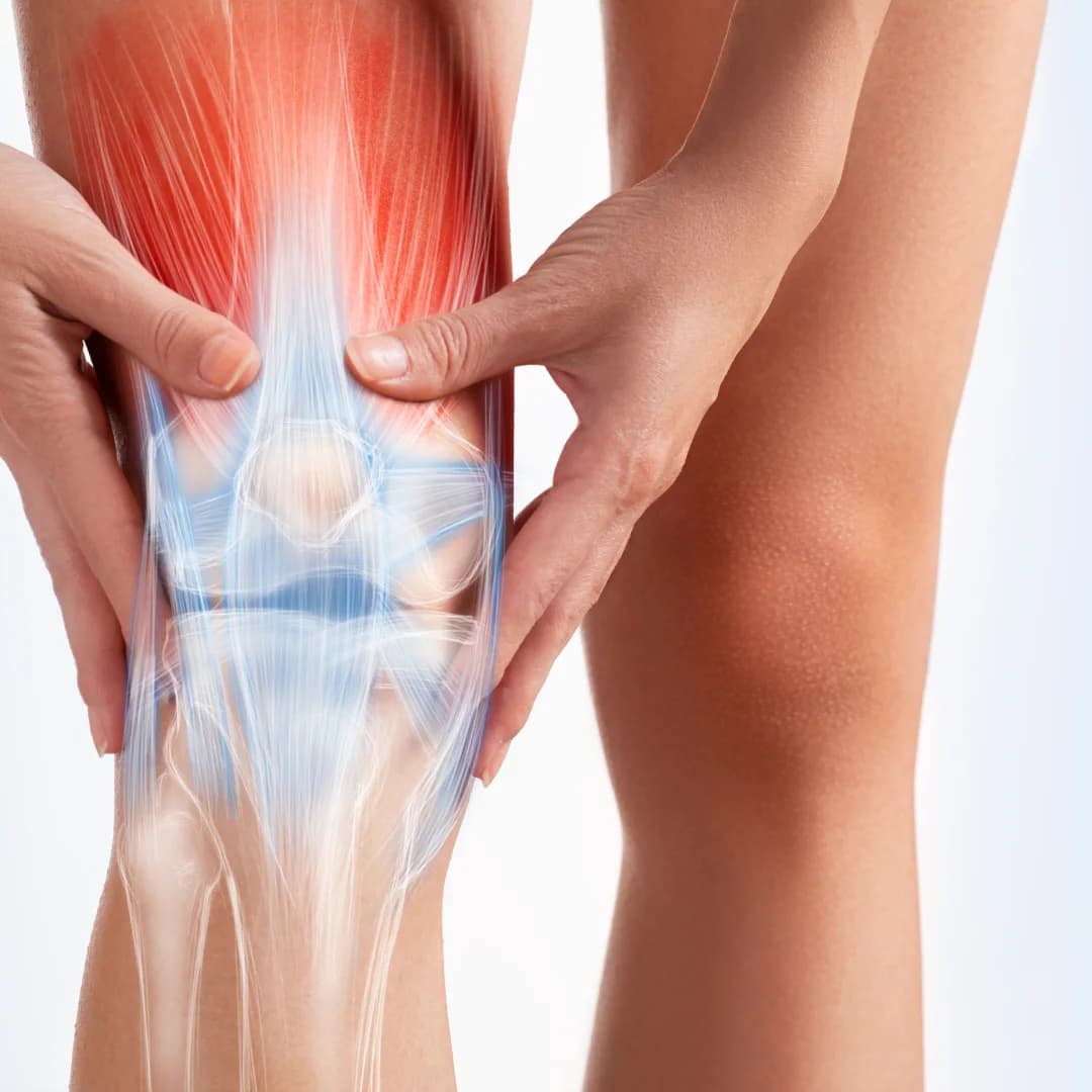 Illustration of a knee with the underlying bones and ligaments shown through the skin, and the muscle above the joint highlighted red