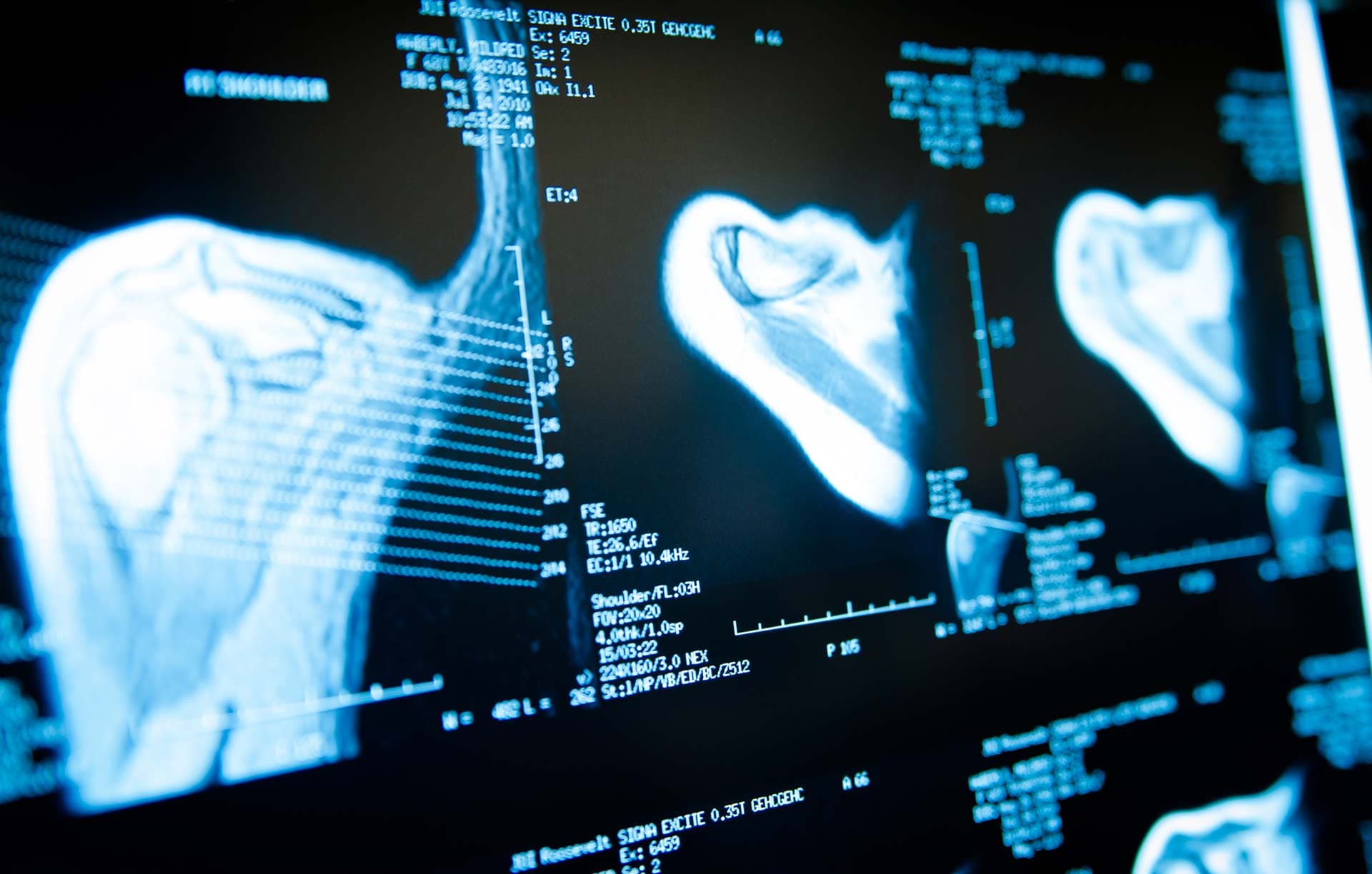 MRI scans of a shoulder and hip displayed on a radiology workstation