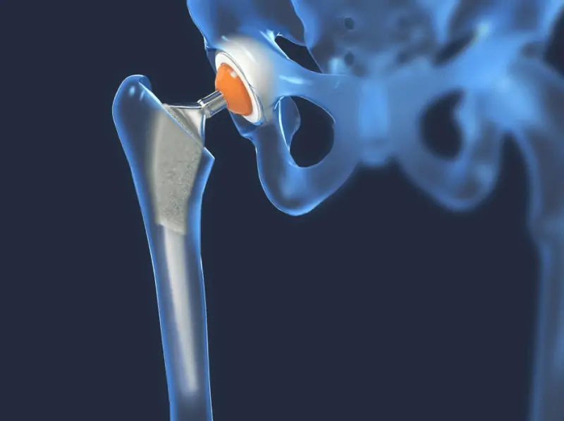 Illustration of a total hip replacement: a metal stem set into the femur with a ball joint seated in the pelvic socket